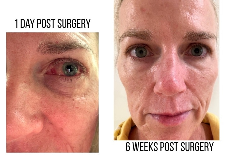 November 2025 - My Eyes 2 detached retina surgery
