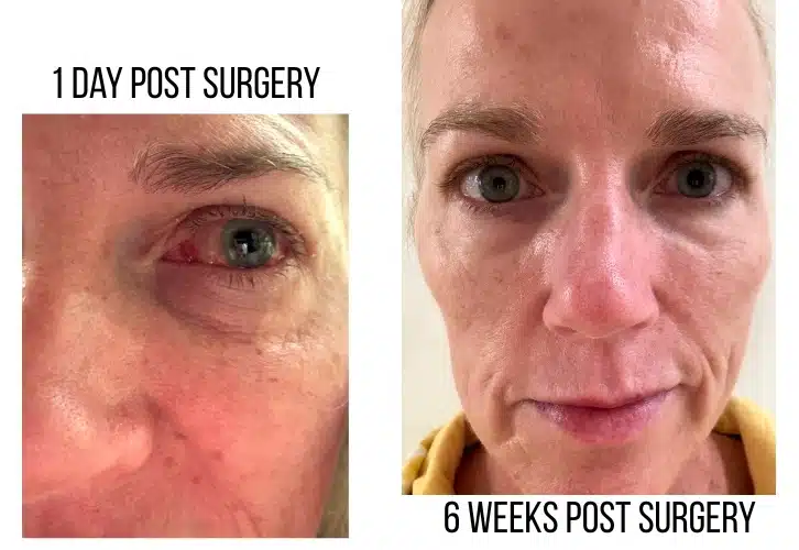 detached retina surgery